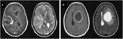 Assessment of Prognostic Value of Cystic Features in Glioblastoma Relative to Sex and Treatment With Standard-of-Care